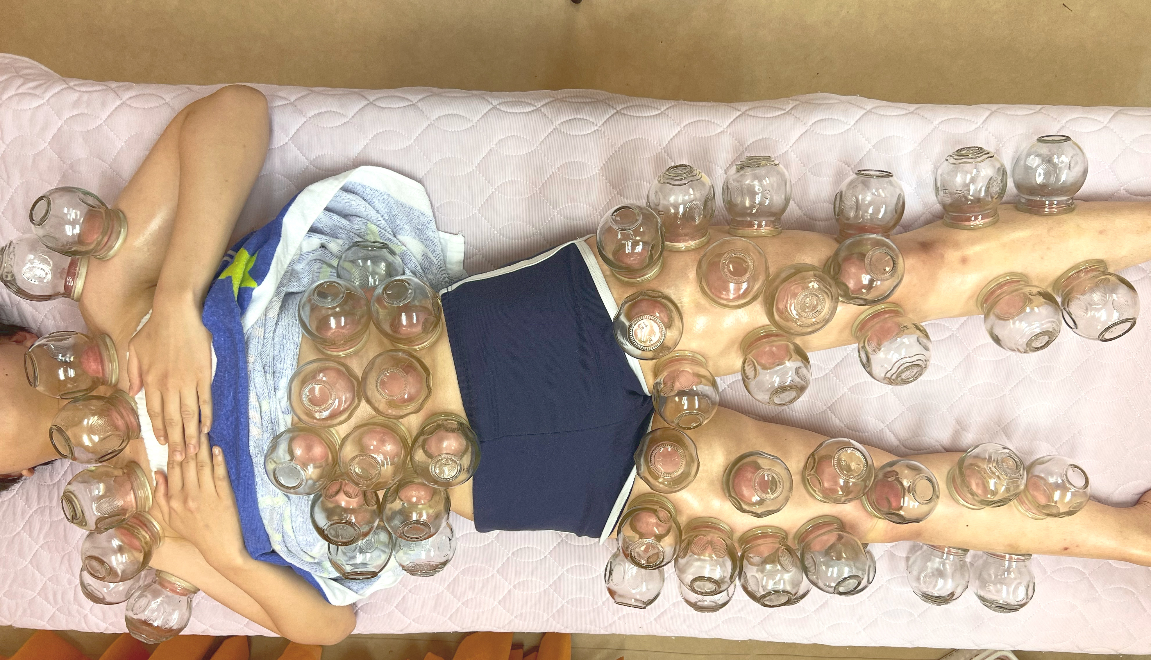 カッピング美肌